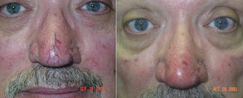 scleortherapy of facial veins scleortherapy of facial veins