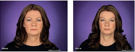 botox treatment4 botox treatment4