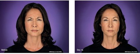 botox treatment3 botox treatment3