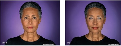 botox treatment2 botox treatment2