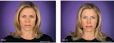 botox treatment1 botox treatment1