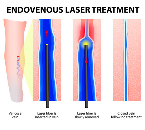 Endovenous Laser Treatment Endovenous Laser Treatment