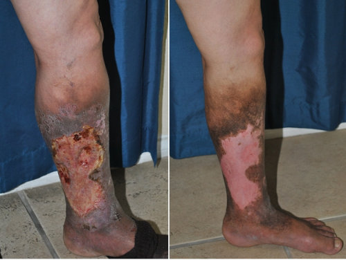 venous stasis ulcer venous stasis ulcer