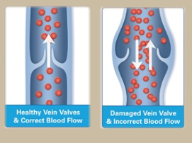 radiofrequency ablation procedure radiofrequency ablation procedure