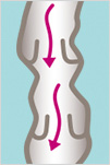 varicose veins varicose veins