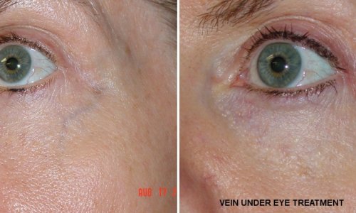 vein under eye treatment1 vein under eye treatment1