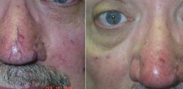 vein nose treatment vein nose treatment