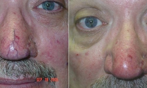 vein nose treatment vein nose treatment