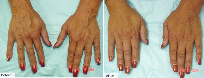vein hands treatment vein hands treatment