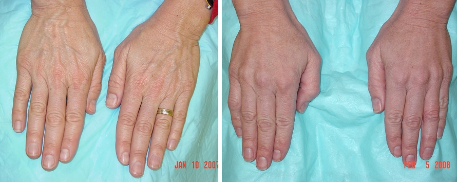 vein hands treatment vein hands treatment