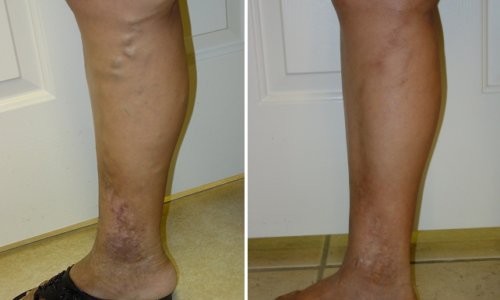 vein legs treatment vein legs treatment