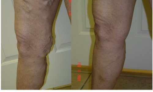 vein legs sclerotherapy vein legs sclerotherapy