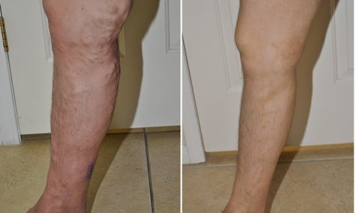 vein legs treatment vein legs treatment