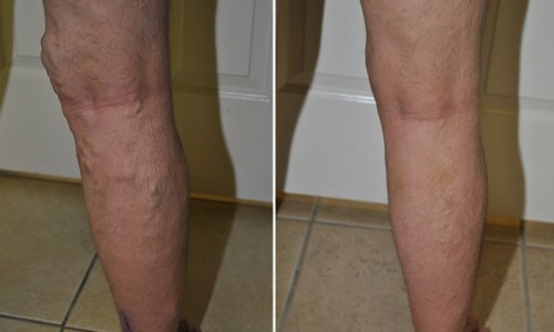 vein legs treatment vein legs treatment