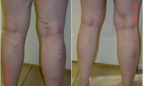 vein legs treatment vein legs treatment