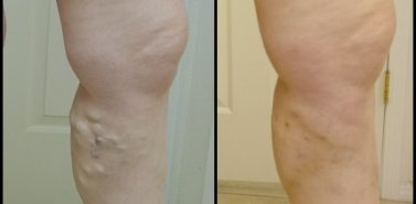 vein legs treatment vein legs treatment