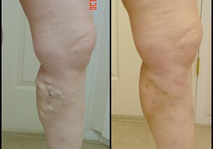 vein legs treatment vein legs treatment