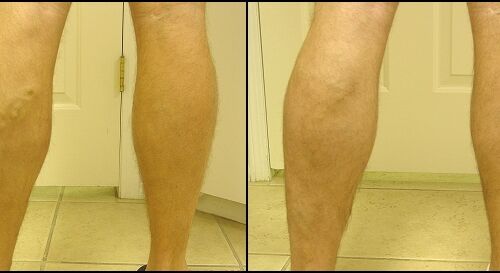 vein legs treatment vein legs treatment