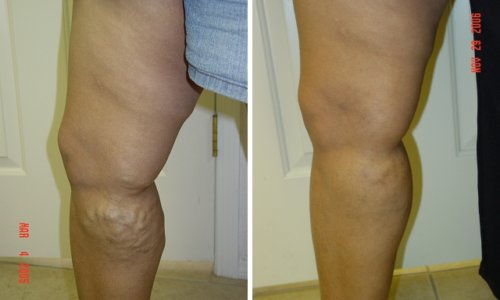 vein legs treatment vein legs treatment
