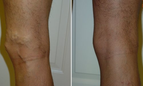 vein legs treatment vein legs treatment