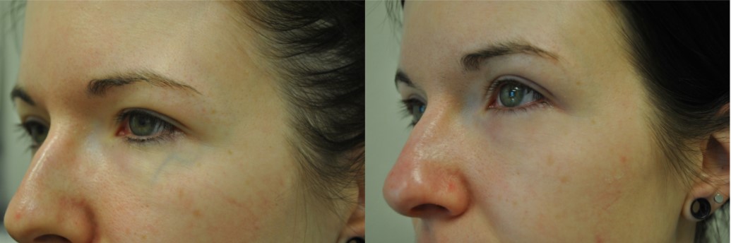beforeafter